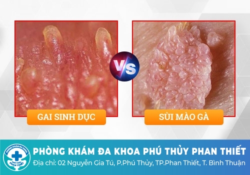 Chuỗi hạt ngọc dương vật có nguy hiểm không?