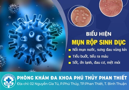 Mụn rộp sinh dục