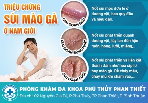 Triệu chứng, dấu hiệu bệnh sùi mào gà ở nam