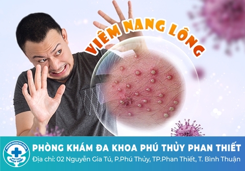 Nổi thịt thừa cửa mình do bệnh viêm nang lông