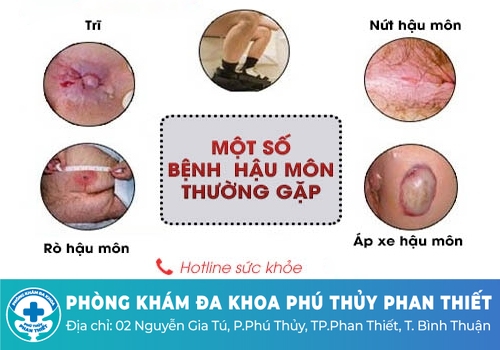 Hậu môn lở loét là bị gì?