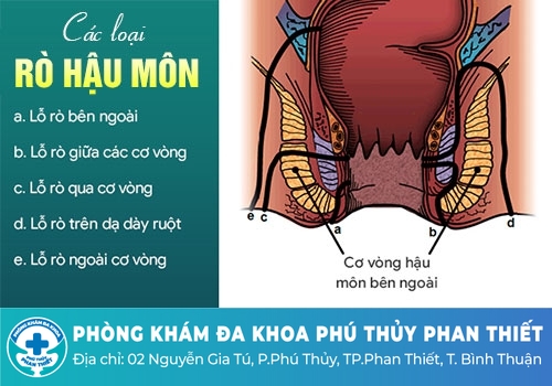 Tổng quan về bệnh rò hậu môn