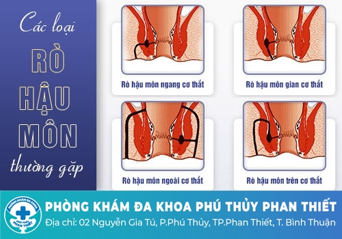 Phẫu thuật rò hậu môn hết bao nhiêu tiền?