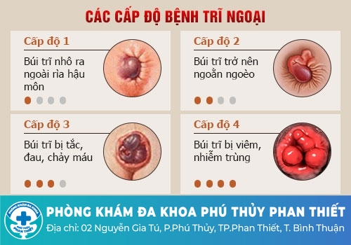 Các triệu chứng điển hình của bệnh trĩ ngoại độ 1
