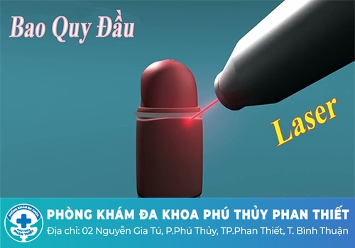 Phương pháp cắt bao quy đầu bằng tia laser