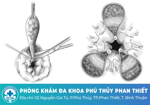 Cách trị sa búi trĩ hiệu quả, an toàn cao