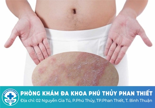 Nấm bẹn