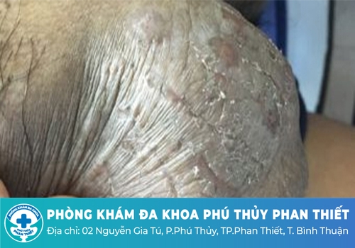 Bệnh chàm bìu có nguy hiểm không?