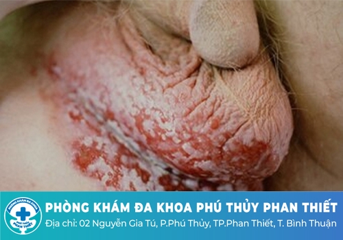 Triệu chứng chàm bìu ở nam giới như thế nào?