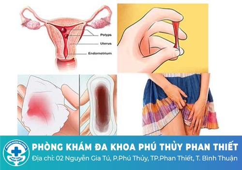 Chảy máu âm đạo nhưng không phải kinh nguyệt là do đâu?