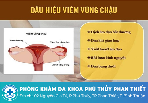 Chua âm đạo do viêm vùng chậu