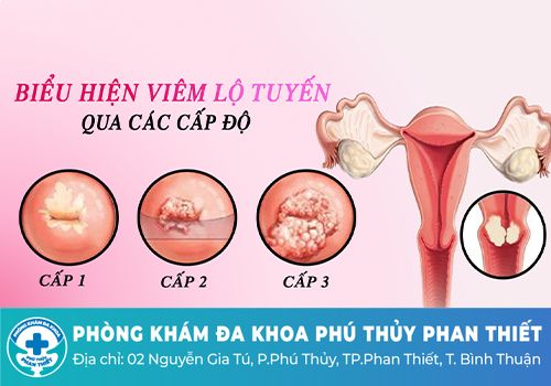 Nguyên nhân ra dịch âm đạo đen là do đâu?
