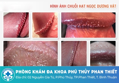 Hạt ngọc dương vật có nguy hiểm không? 