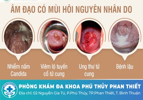 Nguyên nhân gây ra tình trạng hôi vùng kín là gì?