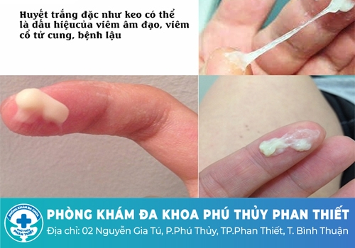 Ra khí hư màu trắng đục là bị gì?