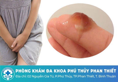 Chua âm đạo biểu hiện của những bệnh lý gì?
