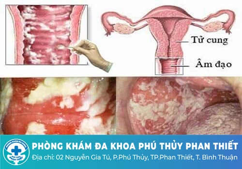 Dịch âm đạo màu trắng sữa có sao không?