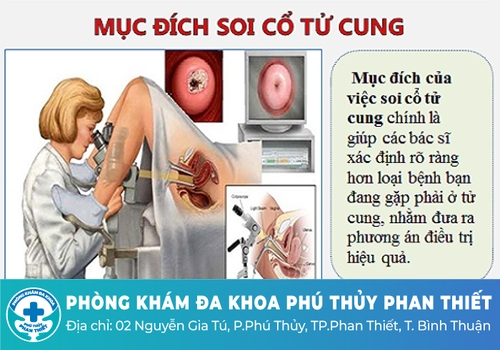 Mục đích của việc soi cổ tử cung