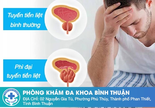 Phì Đại Tuyến Tiền Liệt Có Nguy Hiểm Hay Không? Nguy Cơ Tiềm Ẩn Cần Lưu Ý