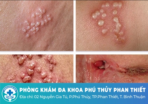 Có điều trị Virus Herps dứt điểm được không?