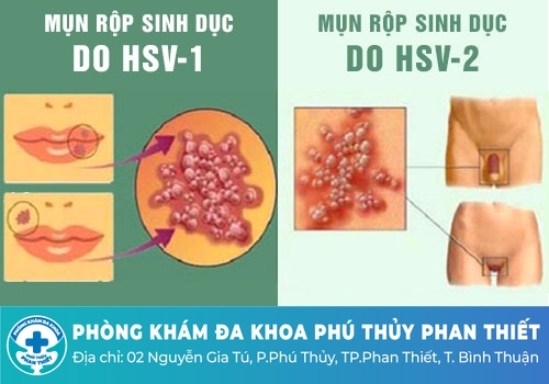Ngứa bộ phận sinh dục nam là bị gì?