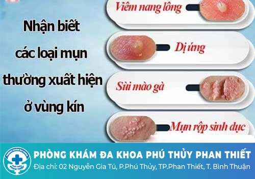 Tình trạng nổi mụn thịt vùng kín nữ là bệnh gì?