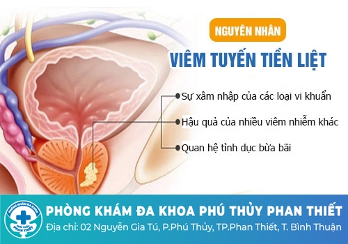 Nguyên nhân gây ra bệnh viêm tuyến tiền liệt