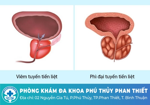 Tiểu buốt ở nam giới do phì đại tuyến tiền liệt