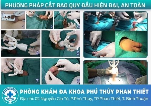 phương pháp cắt bao quy đầu bằng công nghệ Châu Âu