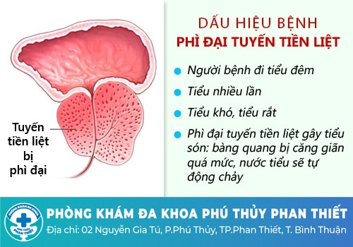 Triệu chứng phì đại tuyền tiền liệt như thế nào?