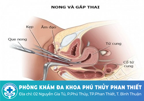 Nong và gắp thai 
