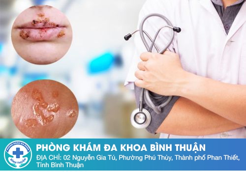 phuong-phap-dieu-tri-benh-ha-cam(1).jpg