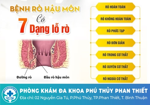 Rò hậu môn là gì? Nguyên nhân gây bệnh