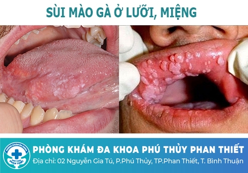 Sùi mào gà ở lưỡi có biểu hiện như thế nào?