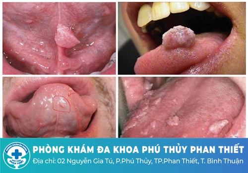 Sùi mào gà ở lưỡi có biểu hiện như thế nào?