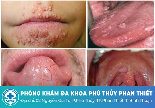 Sùi mào gà ở miệng có biểu hiện như thế nào?