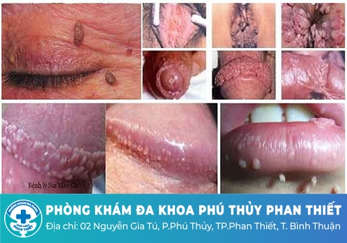 Tổng quan bệnh sùi mào gà ở nam giới