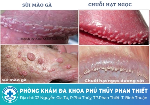 Chuỗi hạt ngọc dương vật có gây ảnh hưởng gì không?