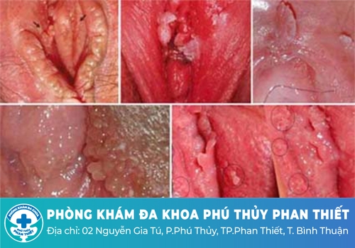 Thịt thừa cửa mình nguy hiểm như thế nào?