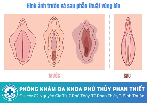 Chỉnh âm đạo bao lâu thì lành?