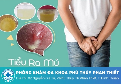Hiện tượng tiểu buốt có mủ ở nam giới