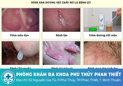 Tiểu buốt chảy mủ là bệnh gì?