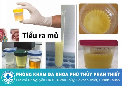 Nam giới tiểu buốt ra mủ là bệnh gì?
