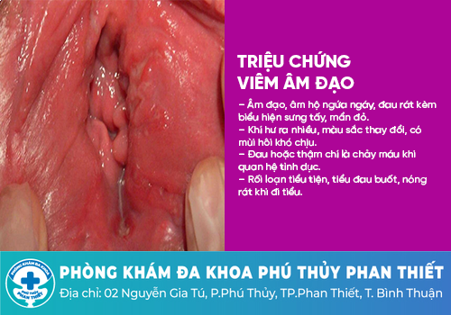 Nguyên nhân khí hư mùi hôi tanh - Bệnh viêm âm đạo