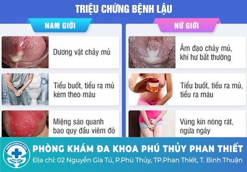 Đi tiểu buốt có mủ ở nam giới là bệnh gì?