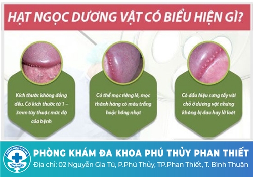 Hạt ngọc dương vật mọc ở đâu? Dấu hiệu nhận biết 