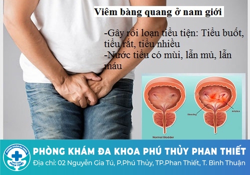 Triệu chứng viêm bàng quang
