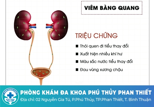 Triệu chứng viêm bàng quang