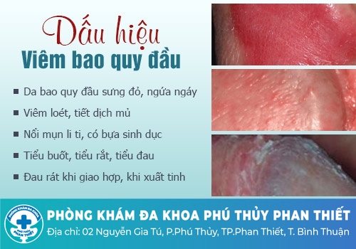 Những bệnh bao quy đầu thường gặp ở nam giới