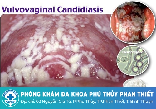 Triệu chứng nấm phụ khoa thường gặp
